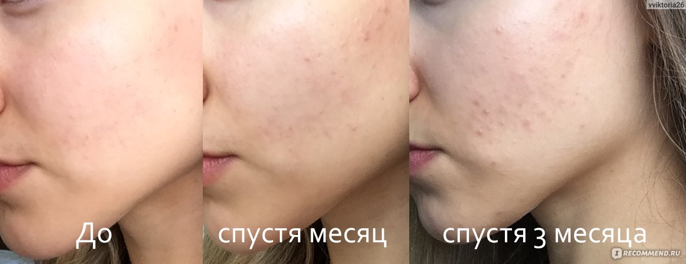 Можно ли курить вейп в 14 лет?